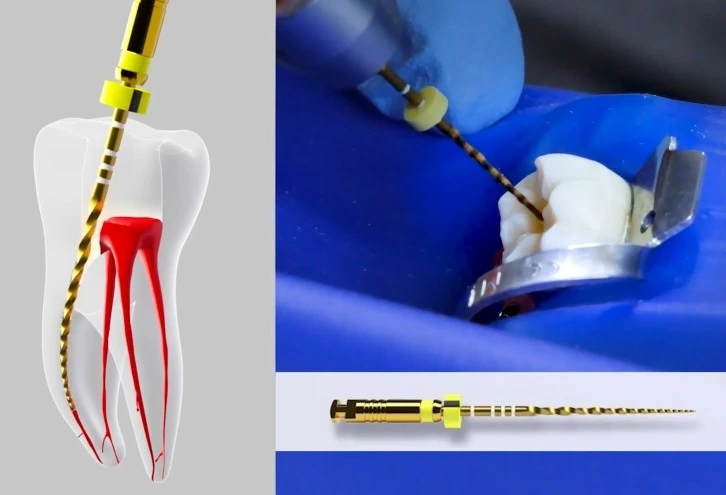 Imagem do curso de Endodontia Automatizada